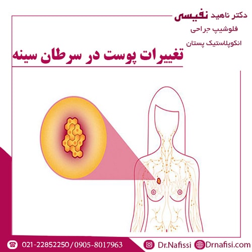 تغییرات پوست در سرطان سینه