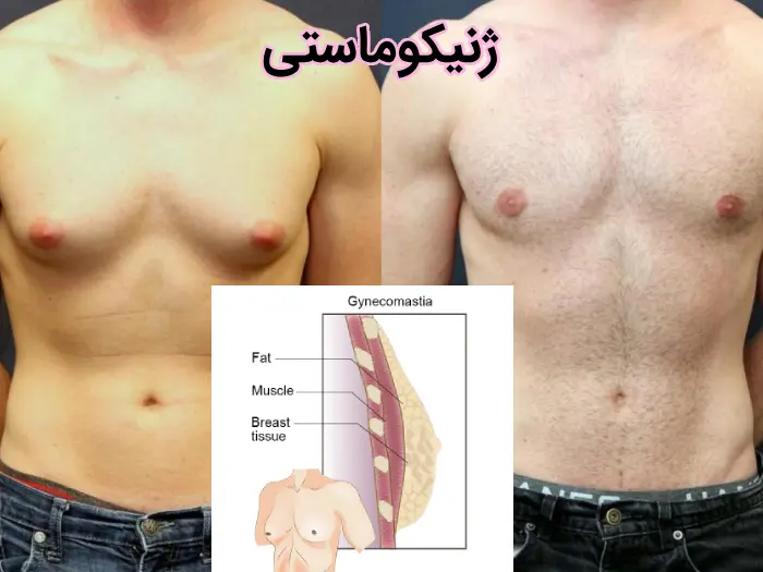 ژنیکوماستی
