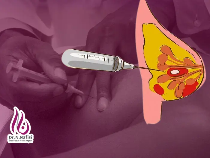 جراحی کیست سینه