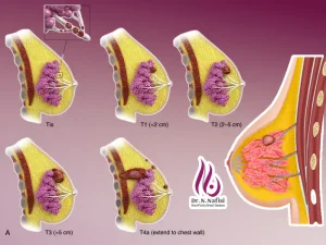 درجه بندی سرطان سینه