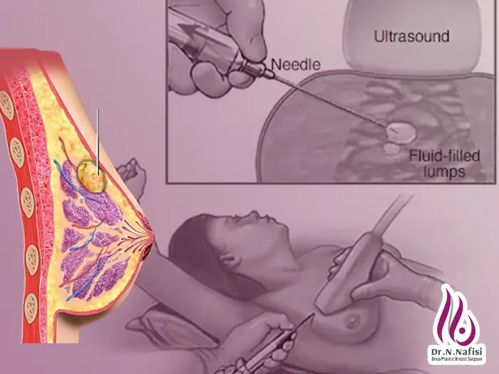 عمل کیست سینه