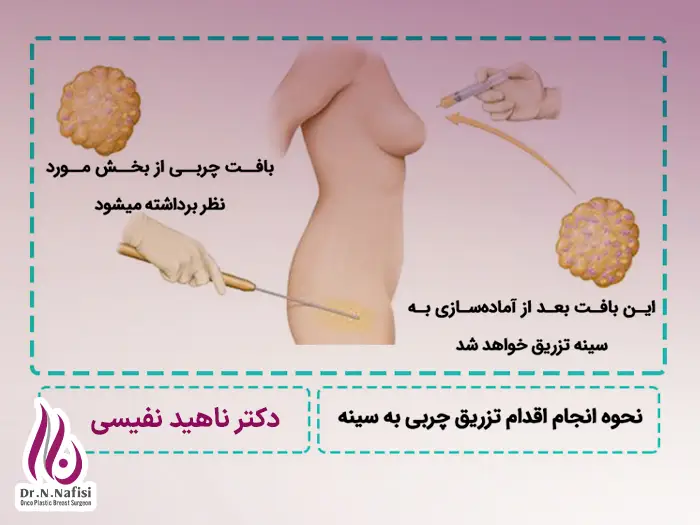 تزریق چربی به سینه