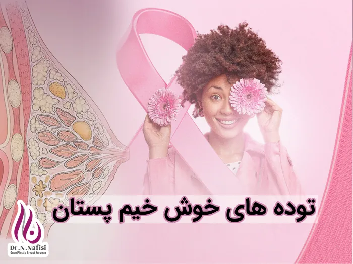 توده های خوش خیم پستان