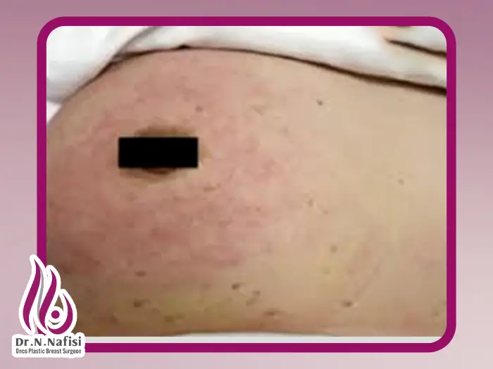 عکس پیشرفت سرطان سینه