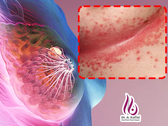 تغییرات پوست در سرطان سینه
