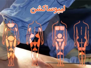 لیپوساکشن