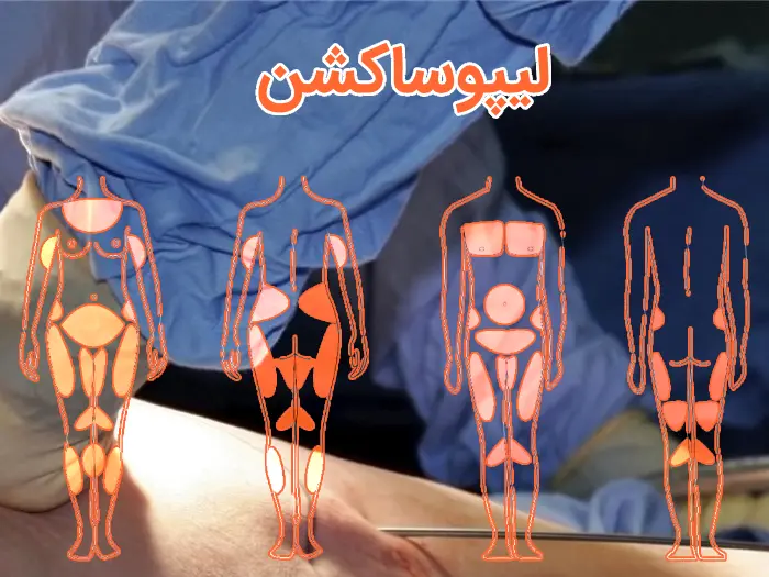 لیپوساکشن