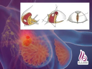 جراحی همزمان سرطان سینه و کاهش حجم پستان