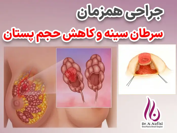 جراحی همزمان سرطان سینه و کاهش حجم پستان
