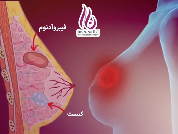فیبروآدنوم 