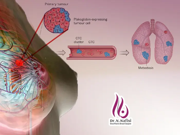 متاستاز سرطان سینه