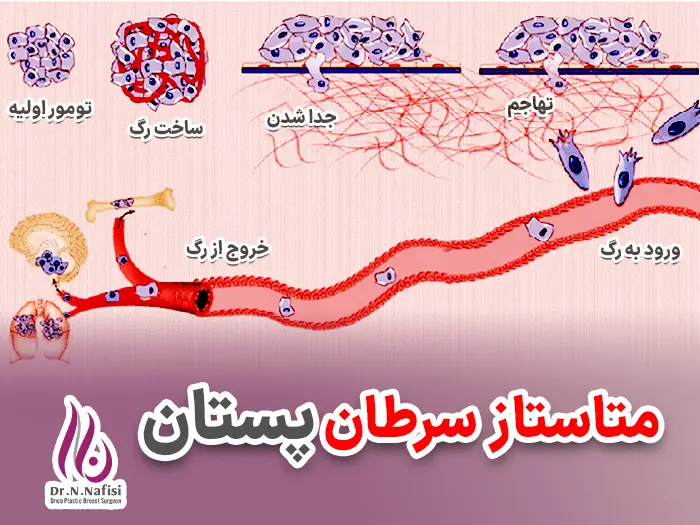 متاستاز سرطان پستان