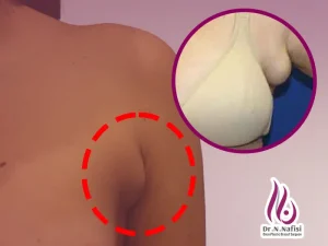 پستان فرعی