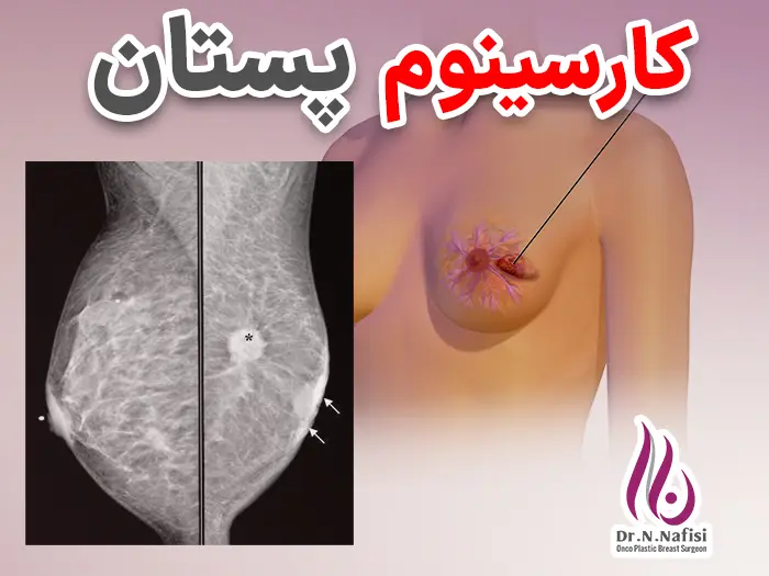 کارسینوم