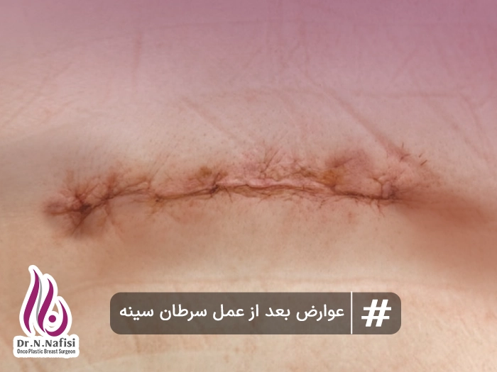 عوارض بعد از عمل سرطان سینه