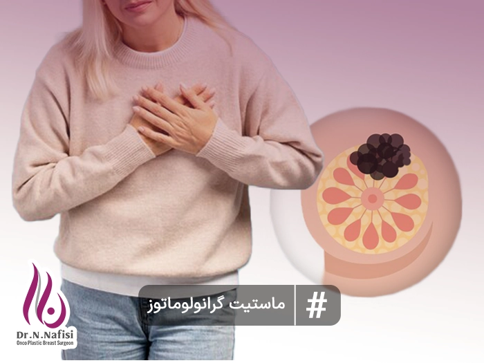 ماستیت گرانولوماتوز چیست