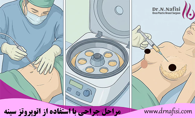 مراحل جراحی با استفاده از اتوپروتز سینه