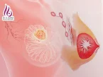 اندازه و مشخصات توده سرطان سینه