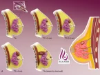 درجه بندی سرطان سینه